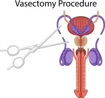 What to Expect at the Valparaiso Vasectomy Clinic: A First-Timer’s Guide