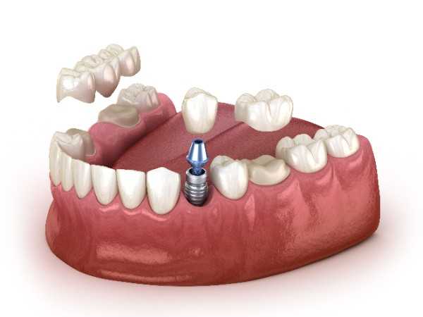 dental implants Workington