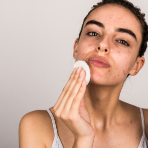 Clearer Skin in Less Time – Try Isotretinoin 40mg Today