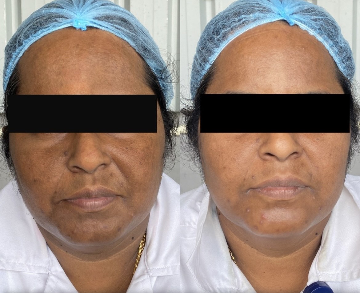 Skin Lightening Treatment in Bangalore – What You Need to Know