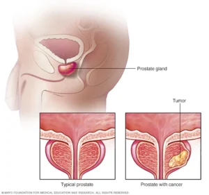 Prostate Disease Explained: BPH, Prostatitis, and Prostate Cancer