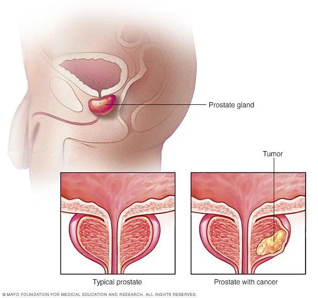 Prostate Disease Explained: BPH, Prostatitis, and Prostate Cancer
