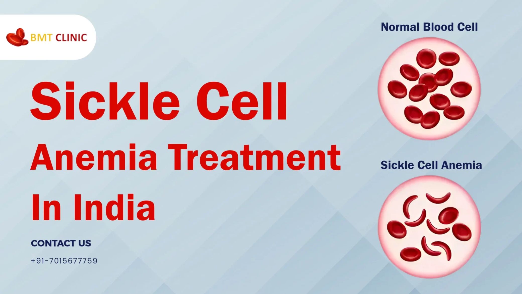 Treating Sickle Cell Anemia in Adults: Challenges and Solutions
