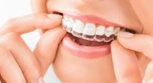 How Invisalign Braces Treatment Works Step-by-step and What To Expect During Treatment