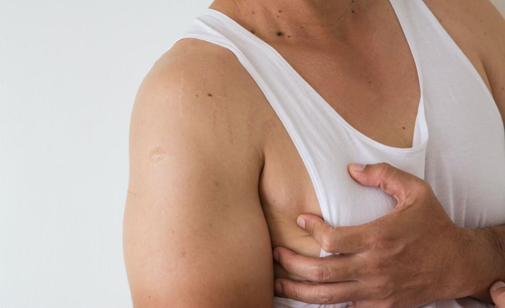 Gynecomastia Surgery in Abu Dhabi: Male Breast Reduction Guide